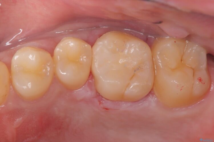 【セラミックインレー】虫歯の再発のリスクを減らして自然な仕上がりに 治療途中画像