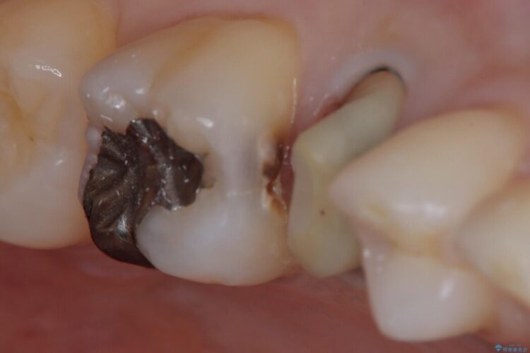 歯髄近くまで広がった深い虫歯を部分的断髄法で治療する 治療途中画像
