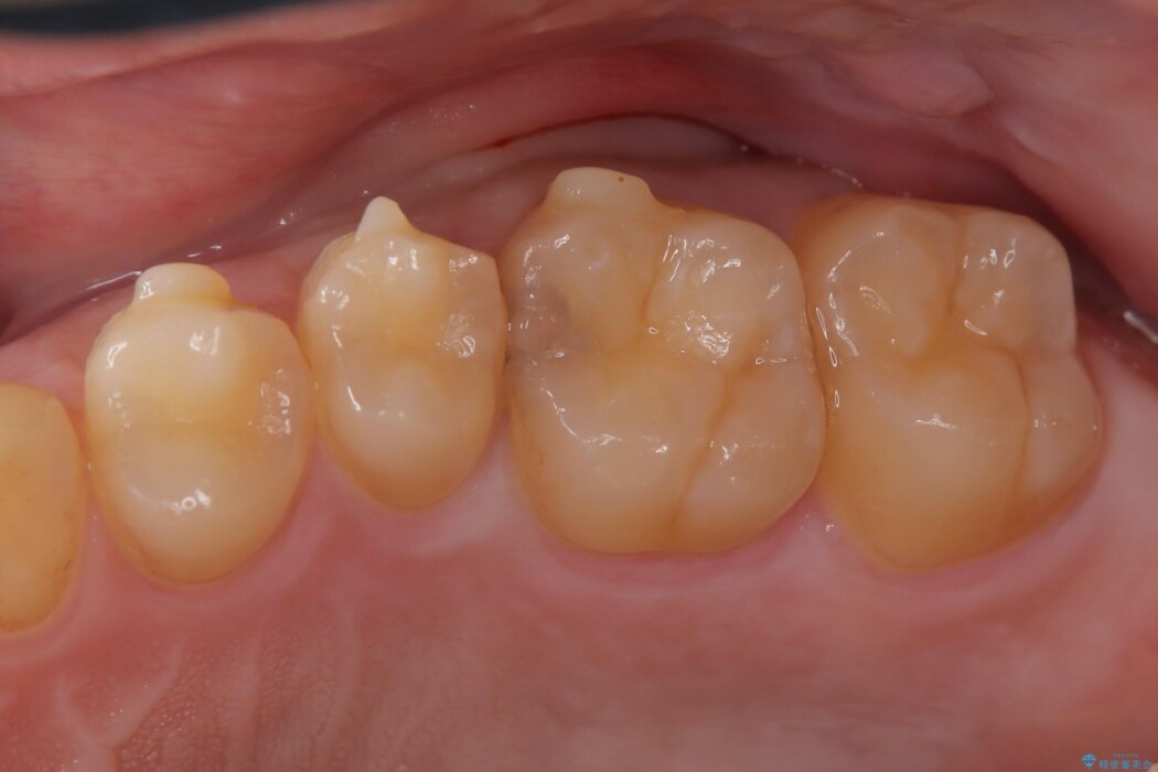 【セラミックインレー】虫歯の再発のリスクを減らして自然な仕上がりに 治療前