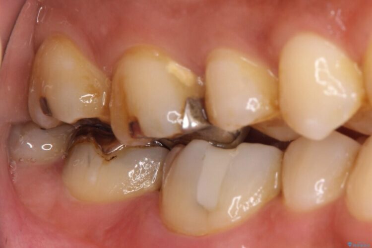 ズキズキと痛む奥の虫歯を根管治療とオールセラミッククラウンで修復 治療前画像