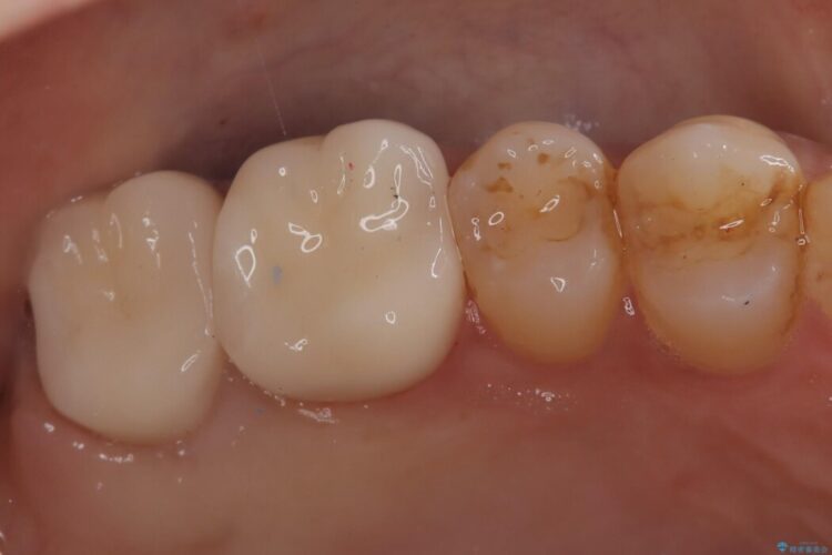 ズキズキと痛む奥の虫歯を根管治療とオールセラミッククラウンで修復 治療後画像