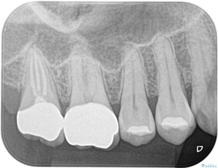 ズキズキと痛む奥の虫歯を根管治療とオールセラミッククラウンで修復 治療後画像