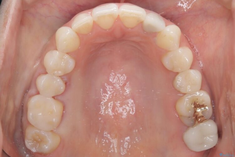 虫歯が多くある方のインビザライン矯正治療 治療後画像