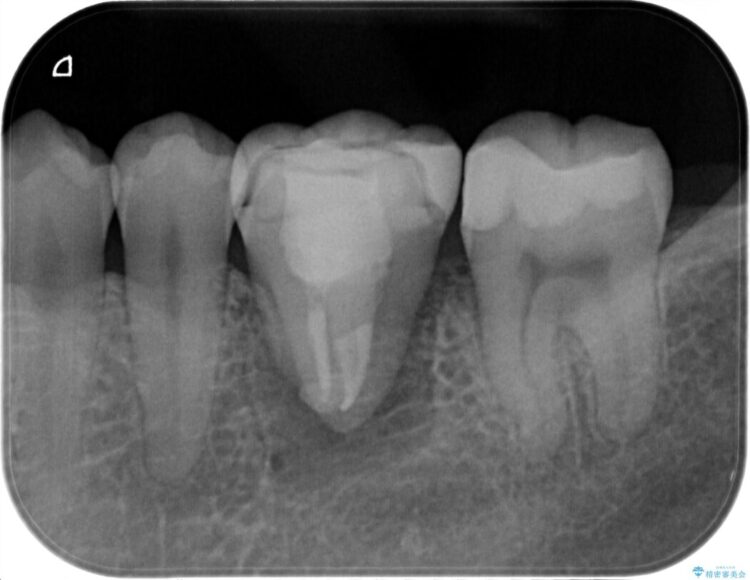 【自家歯牙移植】親知らずを重度の虫歯によって失った部位へと移植する 治療途中画像