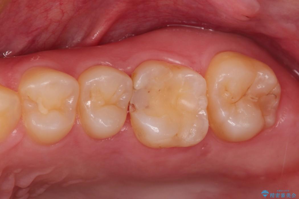 セラミック治療で虫歯の再発（二次カリエス）のリスクを軽減する 治療前