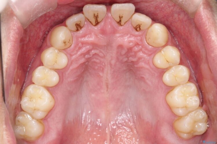 【正中離開】前歯の隙間をインビザラインで閉じる 治療前画像