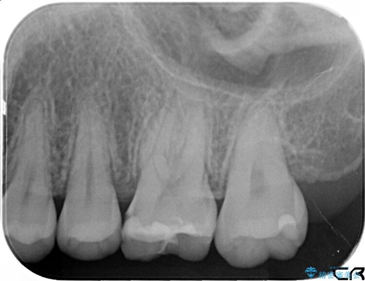 セラミック治療で虫歯の再発（二次カリエス）のリスクを軽減する 治療前画像