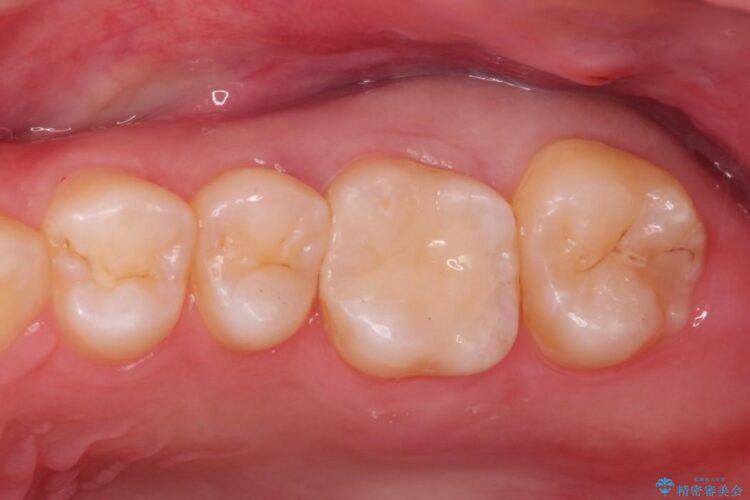 セラミック治療で虫歯の再発（二次カリエス）のリスクを軽減する 治療後画像