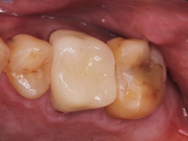 【セラミック治療】他院で治療している歯の痛みが治らない 治療後画像