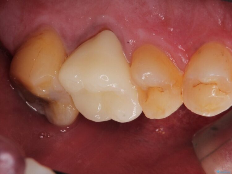 【セラミック治療】他院で治療している歯の痛みが治らない 治療後画像