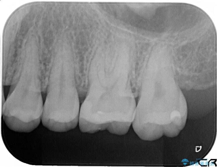 セラミック治療で虫歯の再発（二次カリエス）のリスクを軽減する 治療後画像