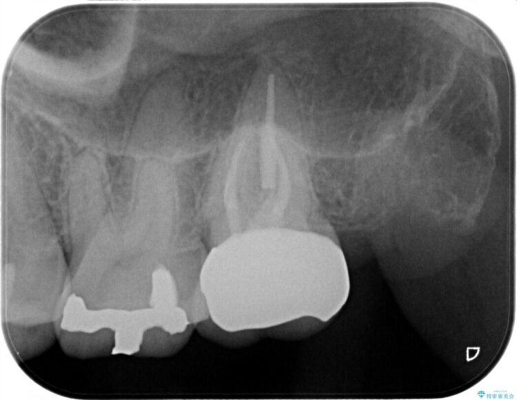常にズキズキと痛む歯を精密根管治療 治療後画像
