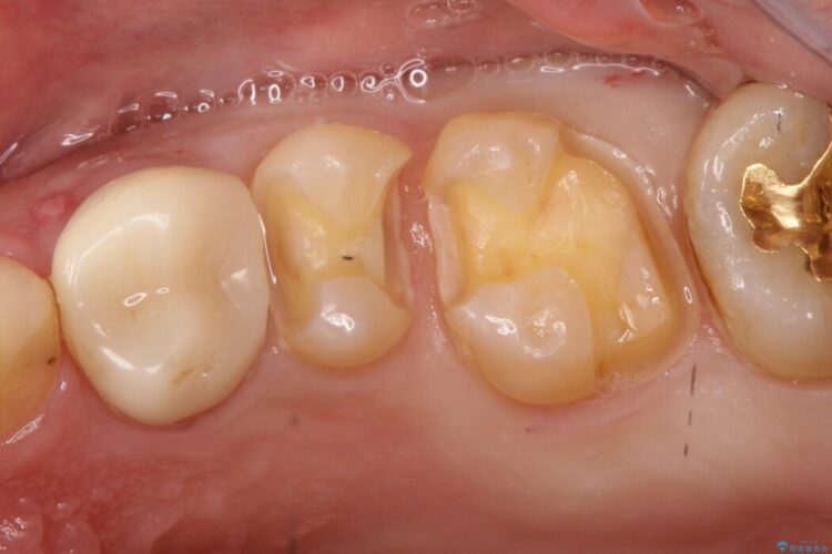 【セラミックインレー】保険治療した場所で虫歯が再発 治療途中画像