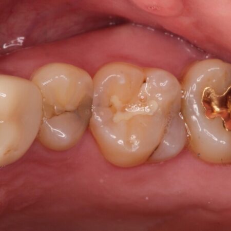 【セラミックインレー】保険治療した場所で虫歯が再発 治療前