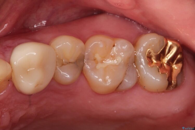 【セラミックインレー】保険治療した場所で虫歯が再発 治療前画像