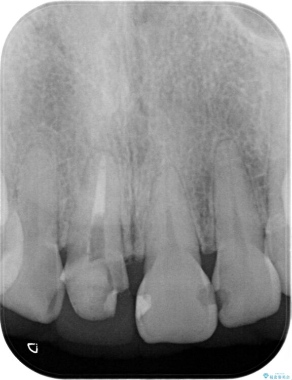 何度も取れる被せ物をやりなおしたい 治療前画像