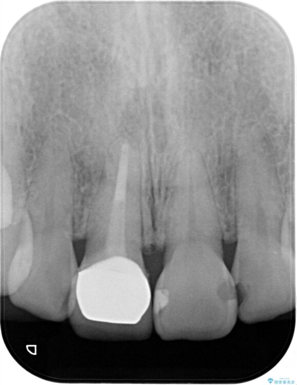 何度も取れる被せ物をやりなおしたい 治療後画像