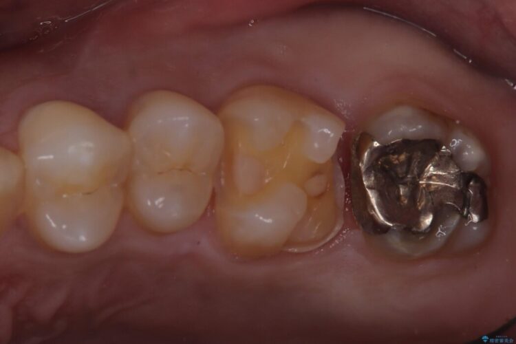 定期検診にて発見した虫歯のセラミック治療 治療途中画像