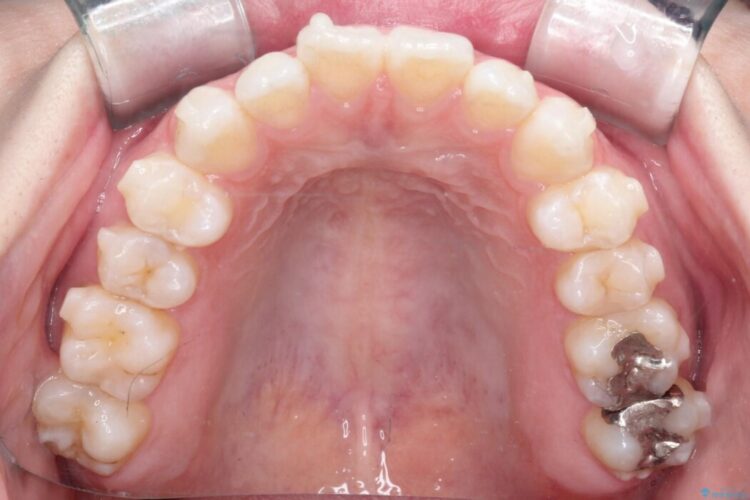 軽度の叢生をインビザラインで整える 治療途中画像