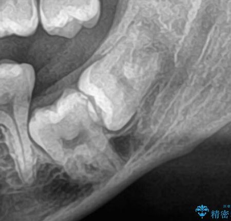 歯列矯正の前に埋没している横向きの親知らずを抜歯する 治療前