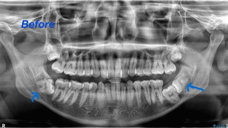 歯列矯正の前に埋没している横向きの親知らずを抜歯する 治療前画像