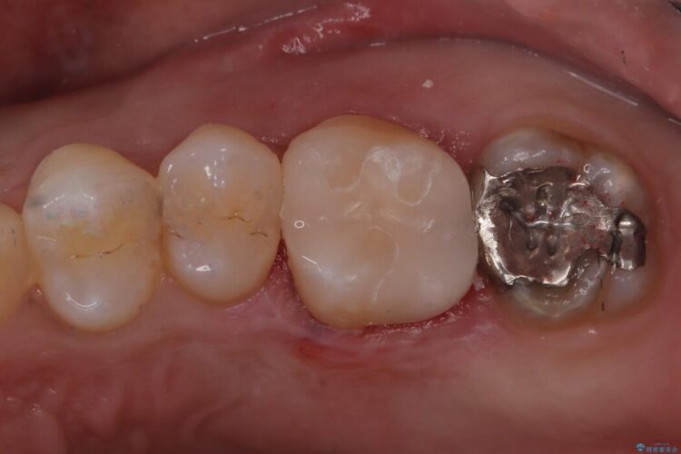 定期検診にて発見した虫歯のセラミック治療 アフター