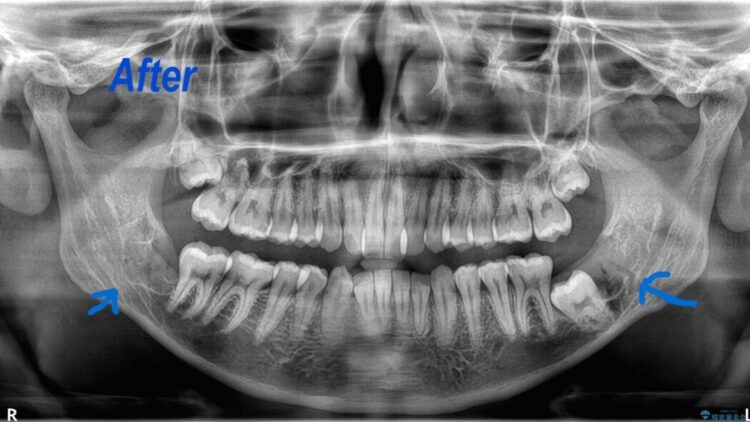 歯列矯正の前に埋没している横向きの親知らずを抜歯する 治療後画像