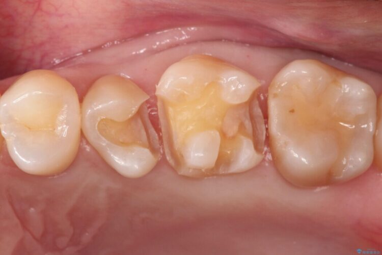 【セラミックインレー】歯と歯の間にできる虫歯 治療途中画像