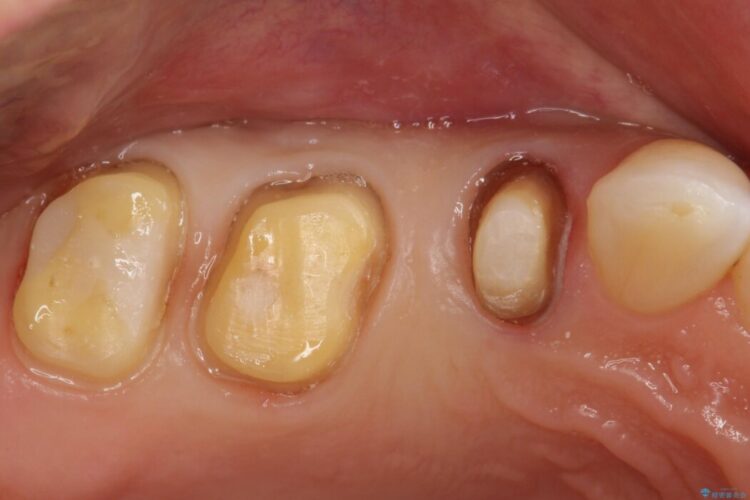 インレー（詰め物）が外れてしまった部分をセラミックで修復 治療途中画像