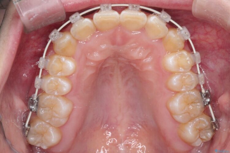【過蓋咬合】深い噛み合わせで下の前歯が見えない 治療途中画像