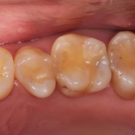 【セラミックインレー】歯と歯の間にできる虫歯 治療前