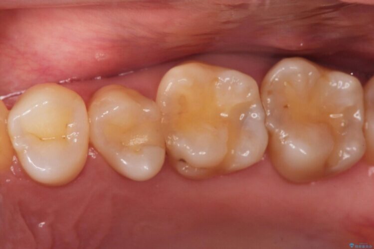 【セラミックインレー】歯と歯の間にできる虫歯 ビフォー