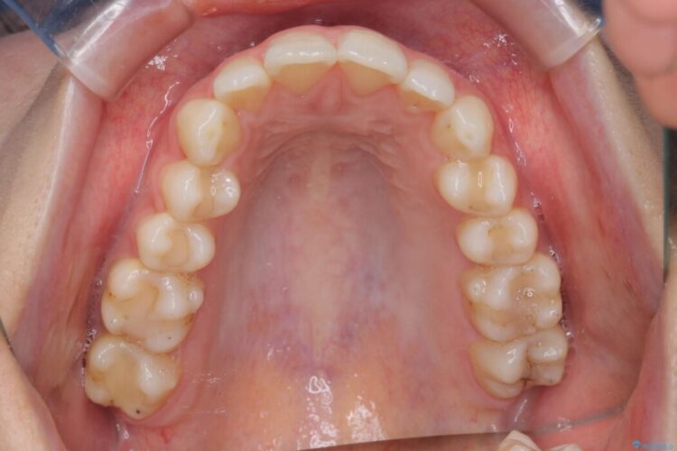 歯列のがたつきをインビザライン矯正 治療前画像