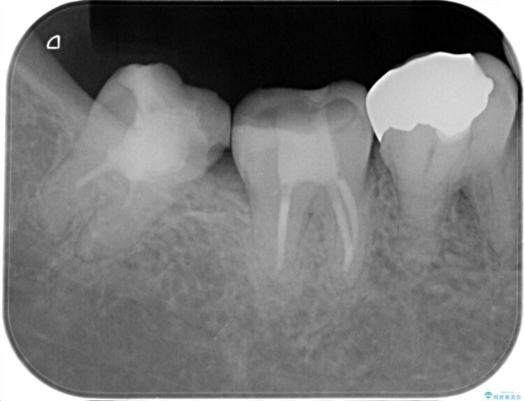 食べ物を噛んだ時に歯がしみる、ズキズキ痛む、長引く痛み。不可逆性歯髄炎の治療 治療後画像