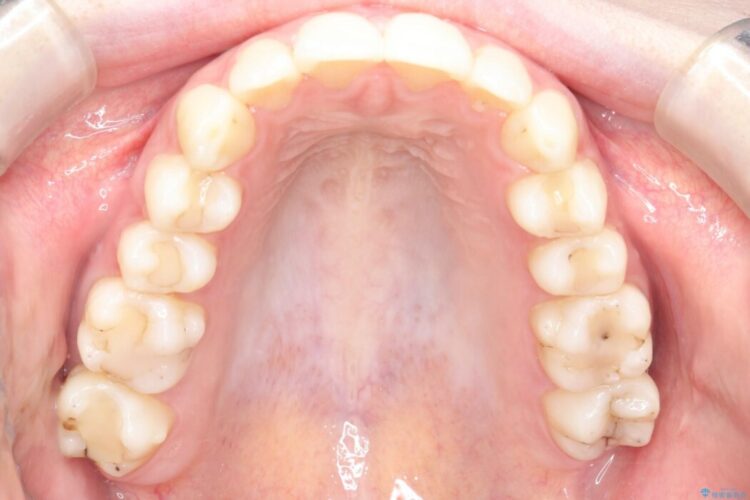 歯列のがたつきをインビザライン矯正 治療後画像